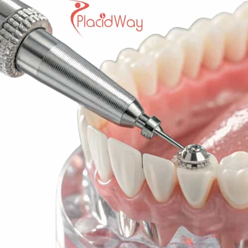 Dental Implants in Hungary for London Patients Seeking European Dental Care